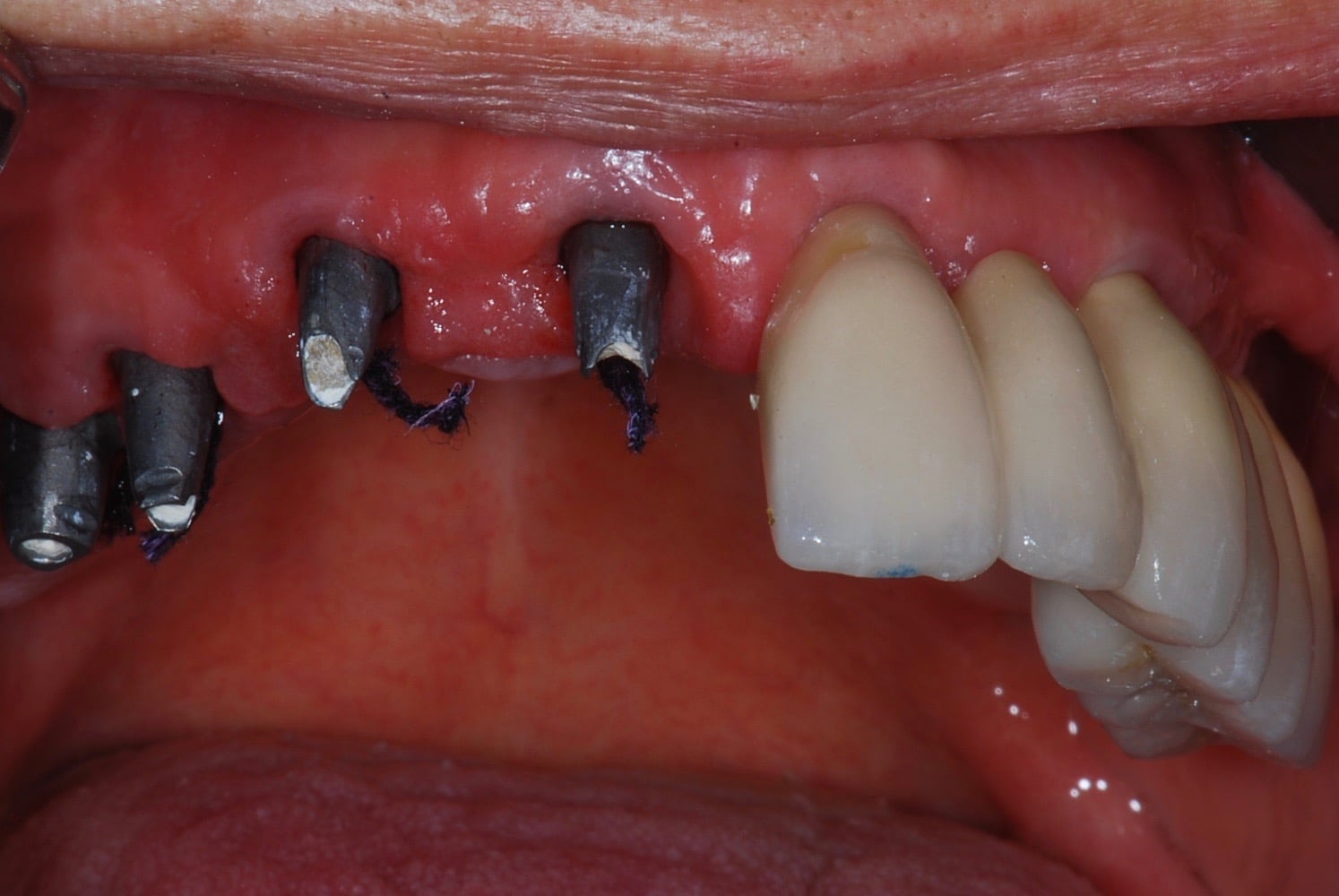 Scellement des bridges céramiques sur implants