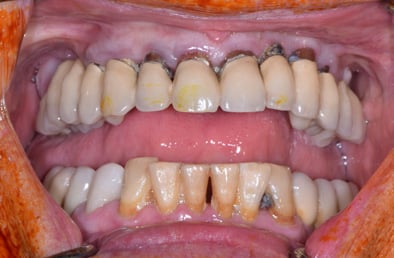 Patient avec dents polycariées sous couronnes non conservables (mâchoire du haut) Même protocole.