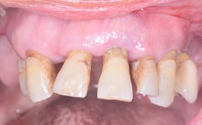 Dents avec perte osseuse terminale ayant migrées et non conservables (demande esthétique de la patiente)