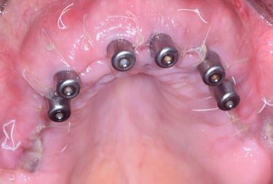 Vue à 48 heures de la chirurgie (extractions de toutes les dents et mise en place des implants simultanément avec ROG)