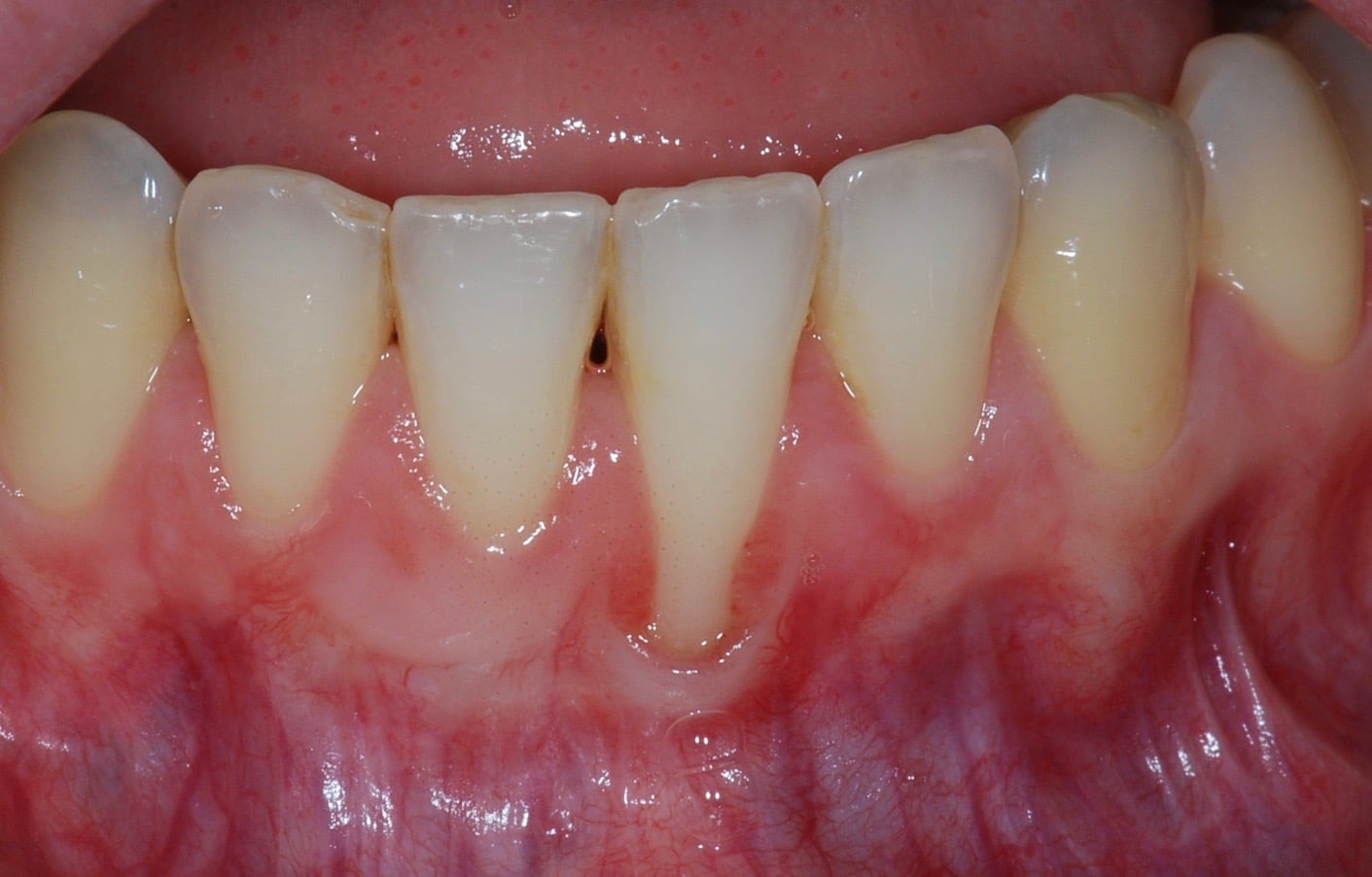 Cas clinique : récession gingivale sur incisive inférieure
