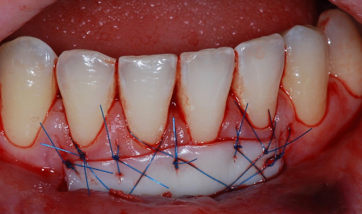 Greffe gingivale épithélio-conjonctive : fin d’intervention