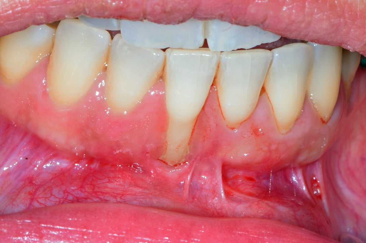 Récession gingivale incisive droite