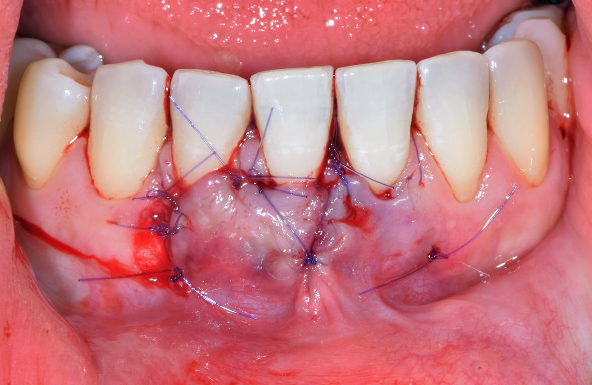 greffon conjonctif et sutures