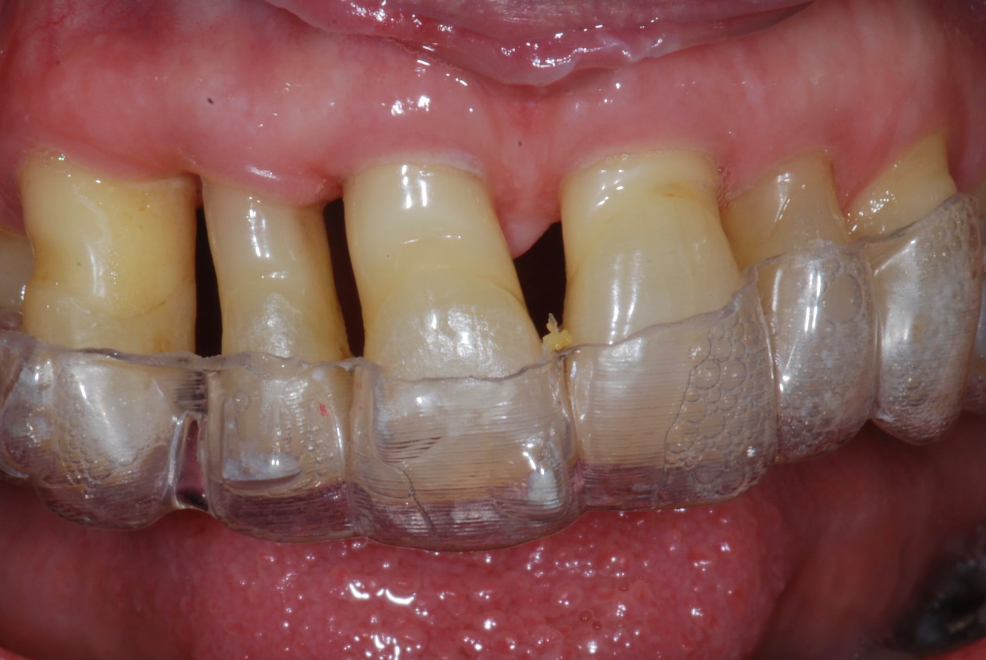Autre cas clinique : Orthodontie avant traitement implantaire