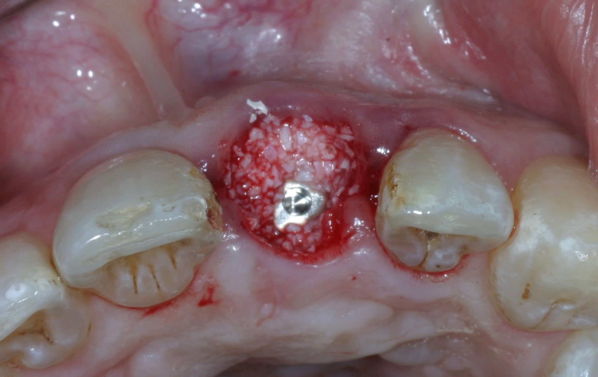 Extraction implantation immédiate et régénération osseuse