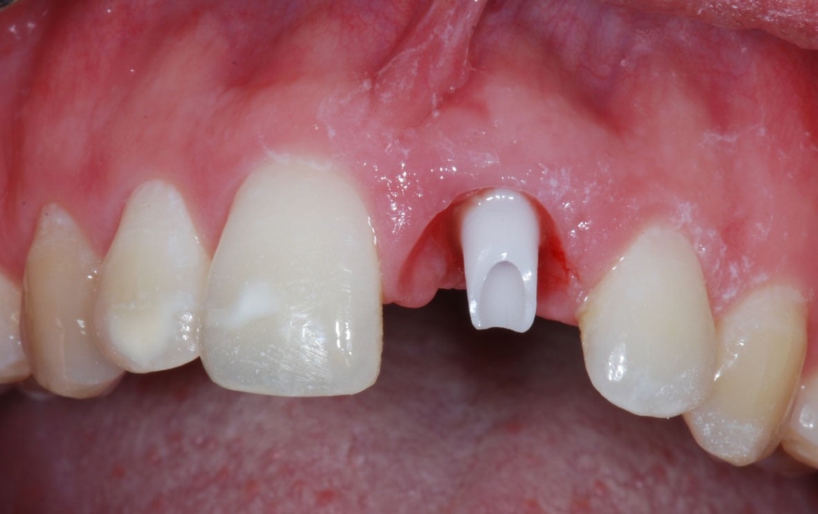 ose du pilier implantaire définitif en zircone