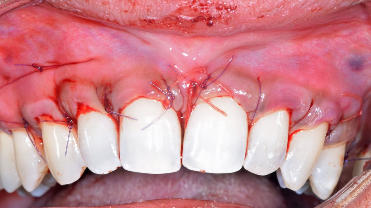 Fin de chirurgie